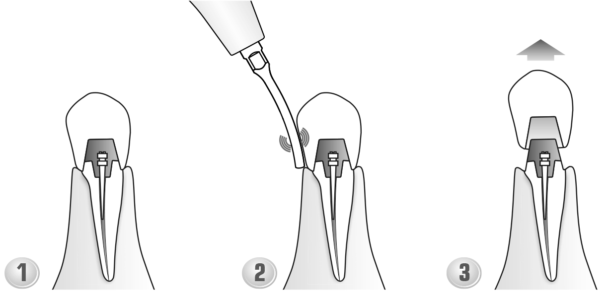 Сфера применения наконечника для скалера